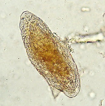 mansoni schistosomiasis